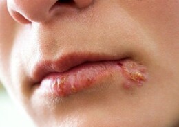 Are cold sores contaious?